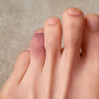 足指打撲か骨折か