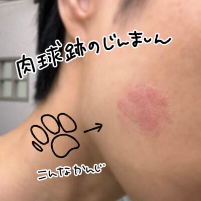 肉球の形で蕁麻疹